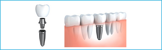 Dental Implants