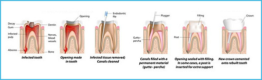 Root Canal