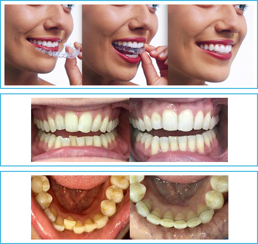 Suresmile Procedure